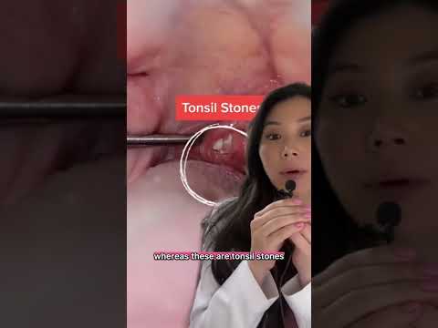 Video: Er forkjølelsessår inne i munnen?
