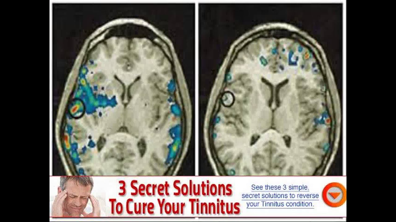 causes of tinnitus and blurred vision YouTube