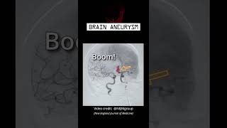 brain aneurysm #stroke