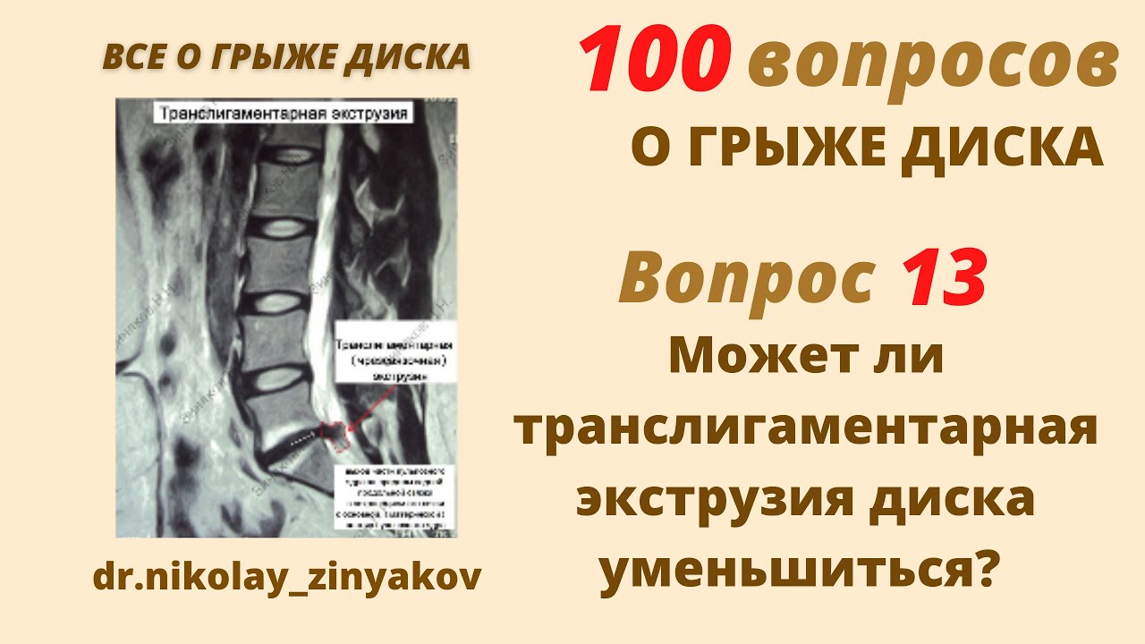 Экструзия дисков шейного отдела позвоночника. Грыжа позвоночника экструзия. Сублигаментарная экструзия диска l4/5. Транслигаментарная грыжа диска. Медианная экструзия диска l5-s1.