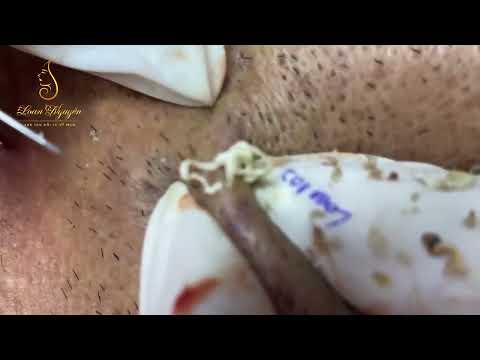 Nice Popping Compilation! With Popping Kit and RESTMORE!