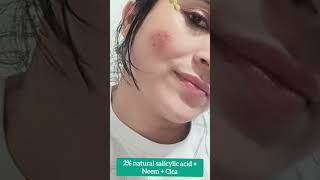 best Himalaya Neem serum for oily pimple skin and acne prone skin #viral #skincareroutine #shorts