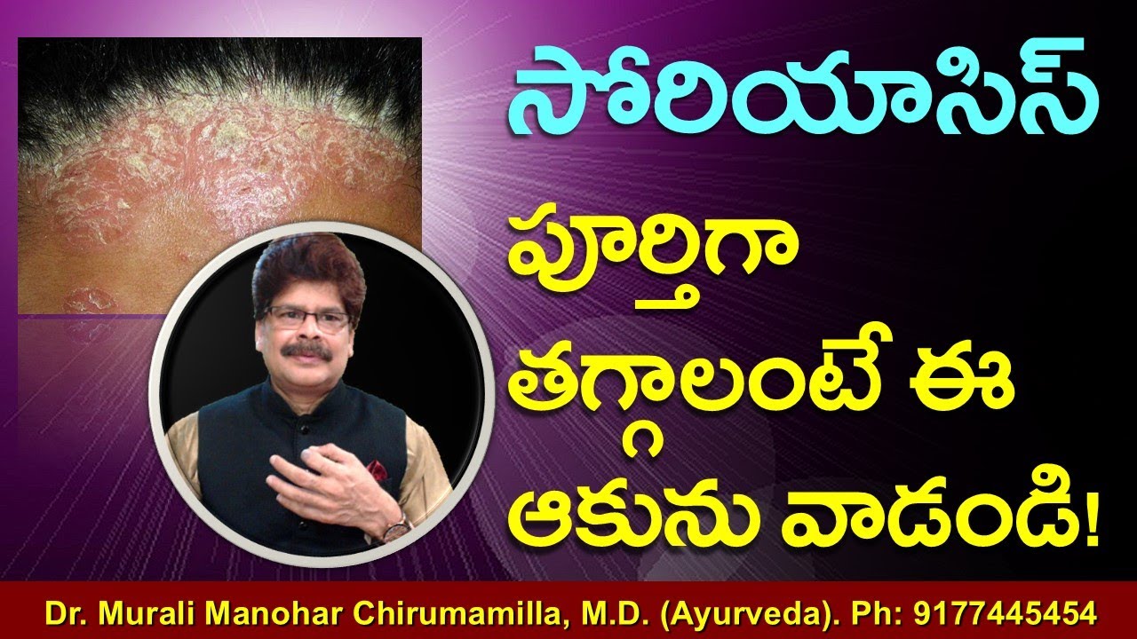 సోరియాసిస్‌: సంక్షిప్త సమాచారం, ఆయుర్వేద చికిత్సలు. Psoriasis and Ayurveda Treatment | Dr. Murali