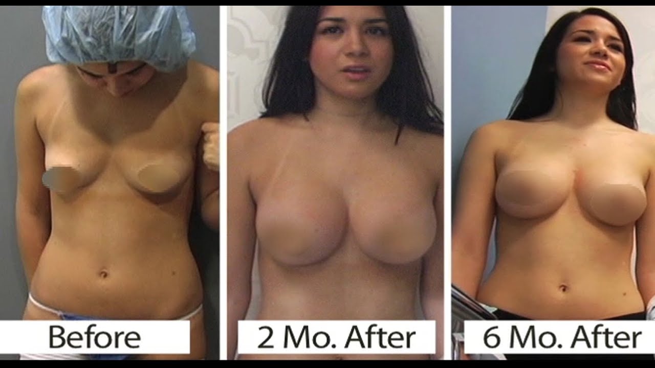 Breast augmentation - before and after video breast augmentation - Yo...