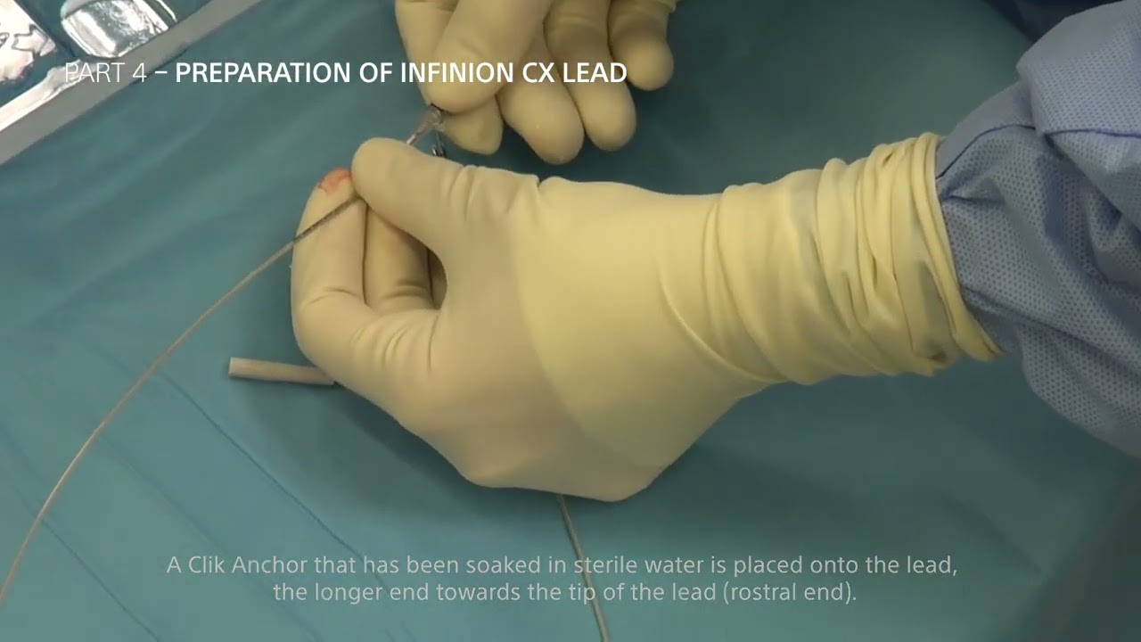 Dr. Georgios Matis - Neuromodulation - Spinal Cord Stimulation - Preparing the Infinion CX lead