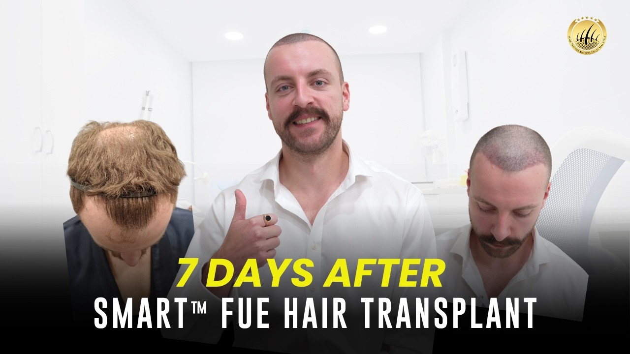Glojas Hair Transplant Specialist Clinic Malaysia | 7 Days Post-SMART™ FUE:UK Patient’s First Review
