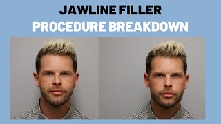 Jawline Filler Procedure Breakdown