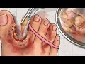 Asmr treatment athletes foot and warts between toes        foot care animation