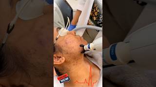 acne removal laser treatment doctor reacts