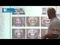 Smile makeover with dental implants and crowns