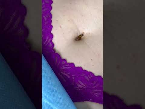 Doctor pulls a bug out of a belly button
