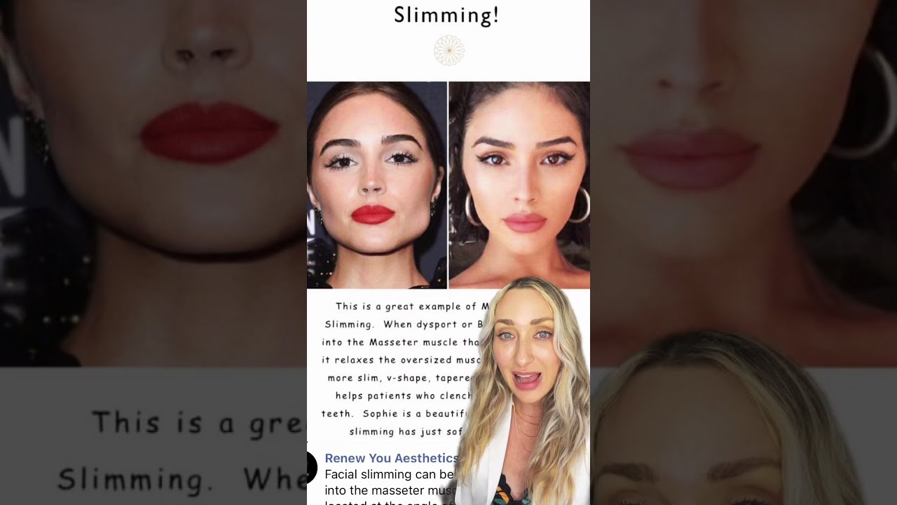 Facial Slimming using Botox! #botox #jawline #dysport #fillers  #antiaging #medspa #beautytips