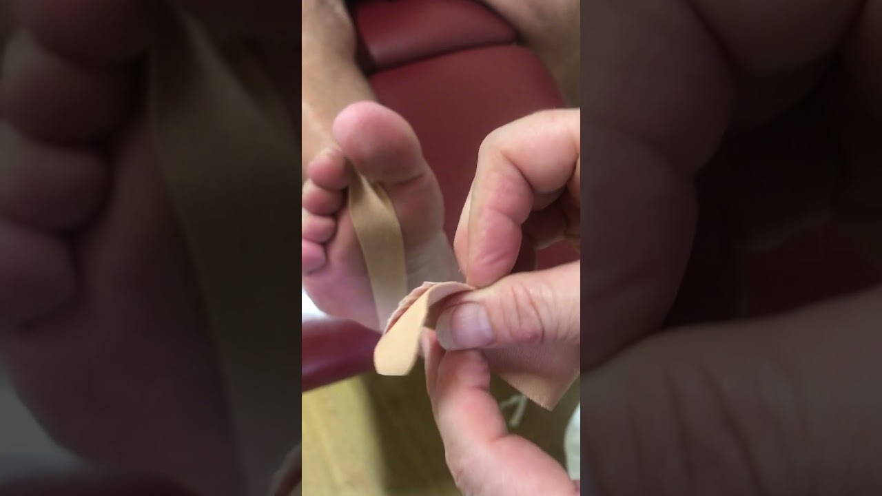 Plantar plate tear strapping