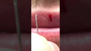 Fordyce spot on lip removal with needle 💉