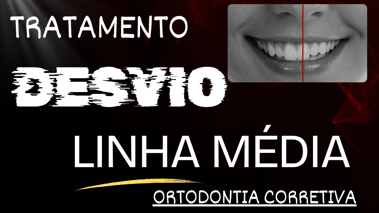 Como tratar o desvio da linha média na 3º fase do tratamento ortodontico? Aula  209