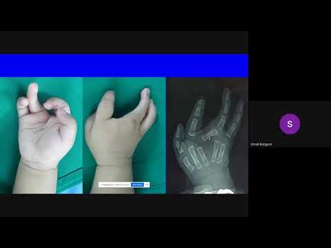 Video: Hvad er en flængehånd?