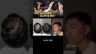 “M자·정수리 탈모, 진짜 변화된 이유｜화가의 손끝 두피디자인”