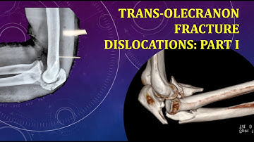 TRANS-OLECRANON FRACTURE DISLOCATIONS PART I (NON-GRAPHIC)