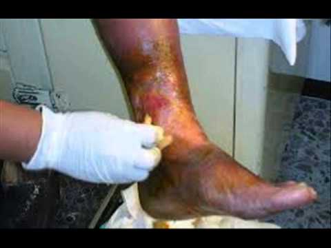 Que provoca la diabetes | Diabetes tipo 1 - YouTube Que provoca la diabetes | Diabetes tipo 1 - YouTube