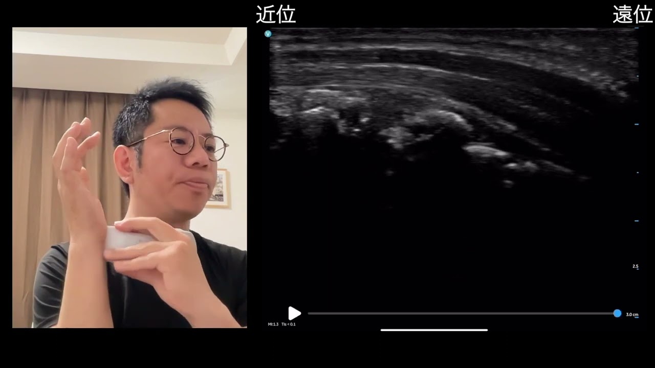 【手根管症候群】正中神経リリース