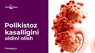 : Polikistozning OSON DAVOSI #PlanBaby #Sperolin #Mammolin #Salomatlikmarkazi