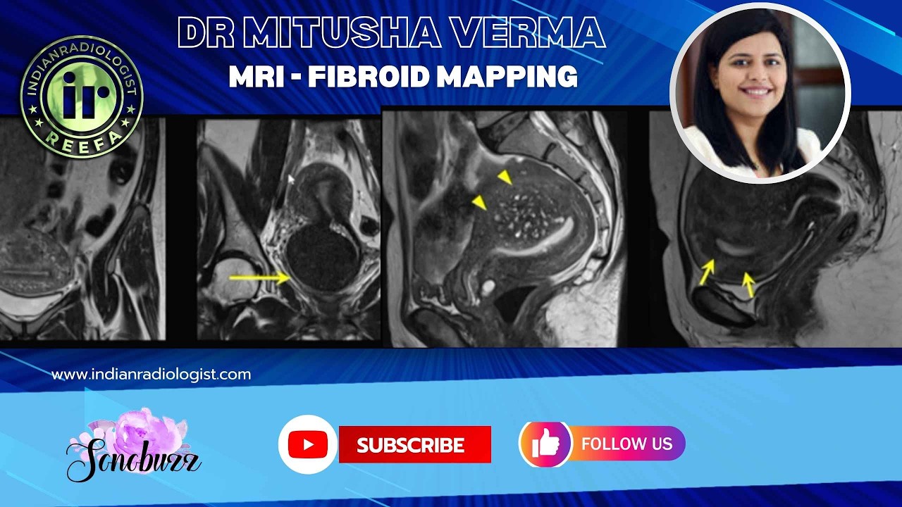 Thumbnail for Dr Mitusha Verma | MRI Fibroid Mapping & FIGO classification #mriteachingcourse