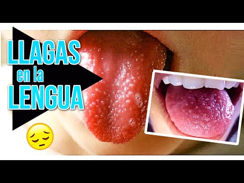 Vídeo: Bultos En La Lengua: Papilas Agrandadas Y Otros Problemas