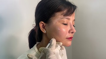 Tiêm botox gọn hàm có đau ko