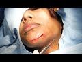 How to Remove Face Scar | Face Scar Removal Surgery by Dr. Sunil Richardson
