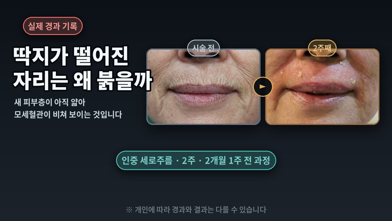 인중 세로주름, 필러도 주름주사도 닿지 않는 깊이 | 해외에서 오신 60대 여성 2개월 1주 경과