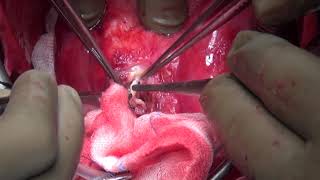 Corona stent infection treatment