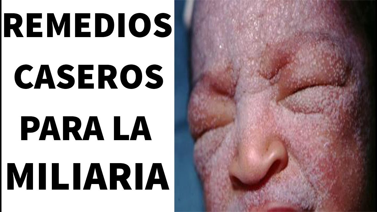 Cómo tratar y curar la “Miliaria” O Sarpullido con remedios caseros