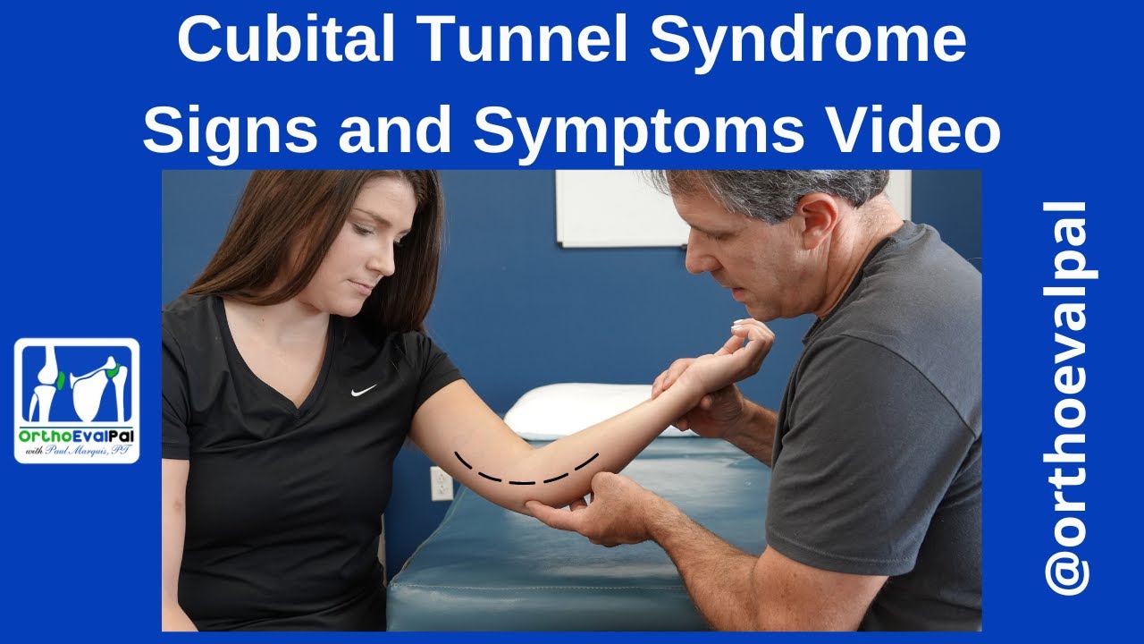 Ulnar Nerve Entrapment at the Elbow (Cubital Tunnel Syndrome