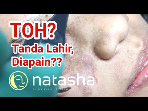 Video: Nevus Berpigmen: Apa Itu, Foto, Jenis, Penyebab Penampilan