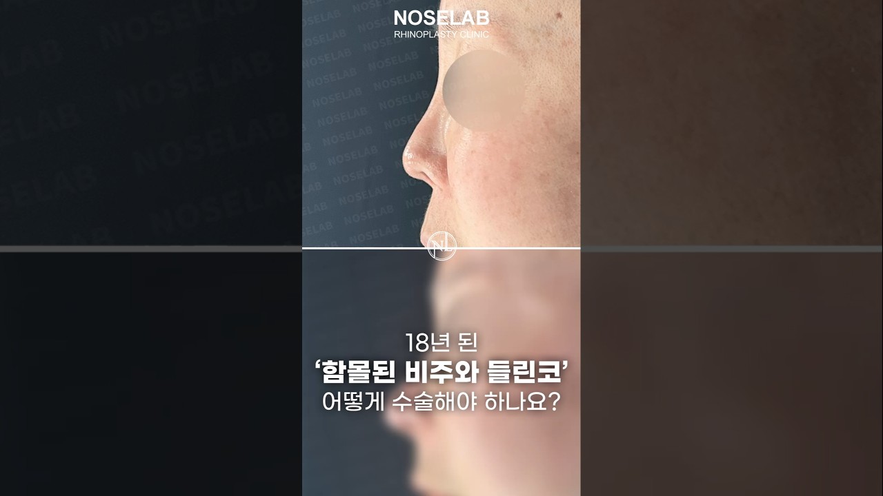 비공노출 들린코 재수술 자가늑연골 교정
