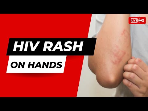 Video: Rash on the hands - the most common causes and treatment