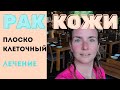 Рак кожи.Плоскоклеточный рак - ПРК. НЕ ПУТАТЬ с бородавкой. Самодиагностика. Виды Лечения и прогноз.