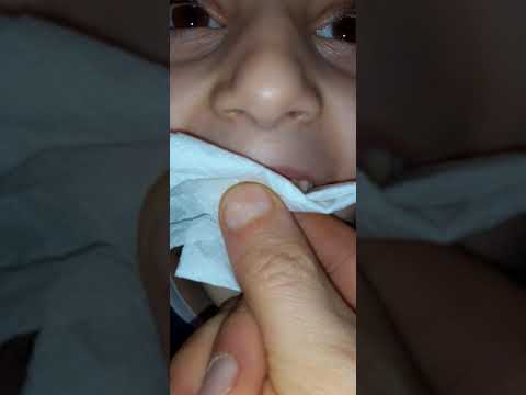 Video: Չամրացված մանկական ատամը ցավազուրկ դուրս հանելու 4 եղանակ