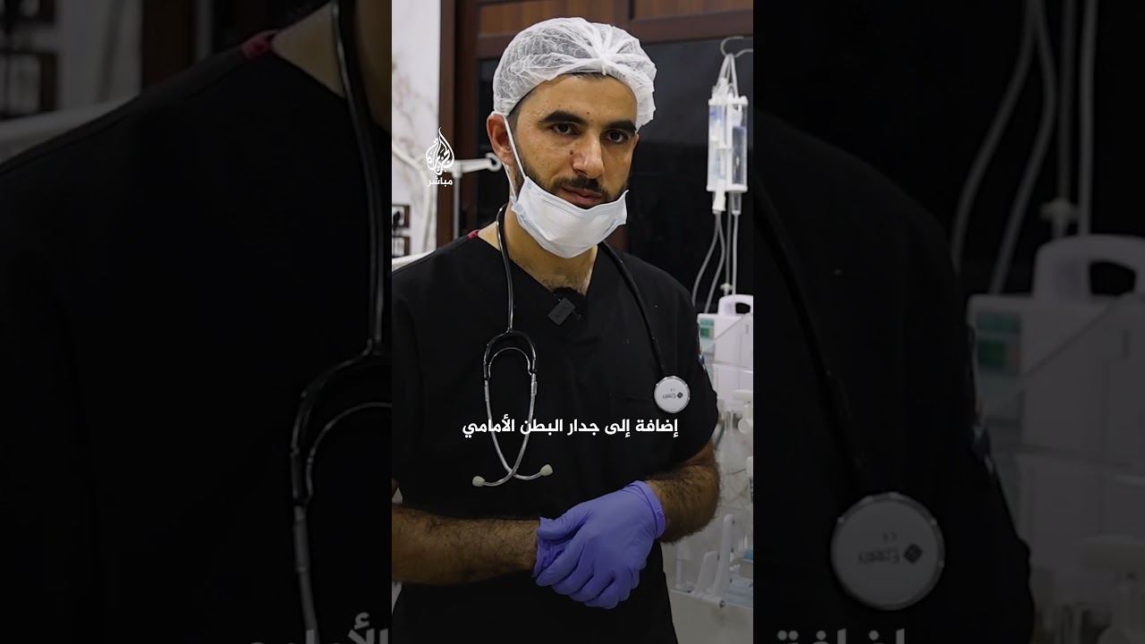 "بقلب واحد فقط".. ولادة نادرة لتوأم متلاصق في مدينة دركوش شمالي #سوريا