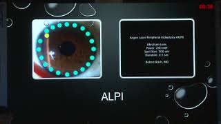 AIOC 2026   IC396   T Dr K  Subashini Management Options and Outcomes of Angle Closure Glaucoma in Y