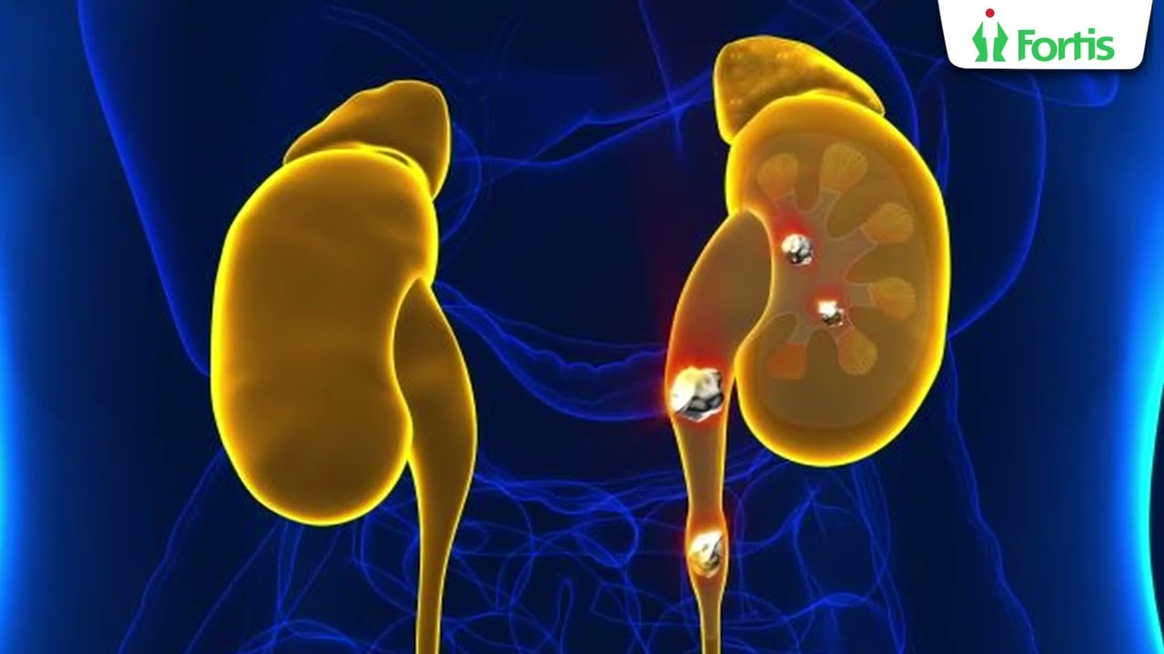 Dr. Anup Gulati on Quanta Cyber Ho 150 Laser: Precise, minimally invasive kidney stone treatment