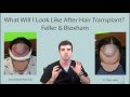 What Will I Look Like After Hair Transplant? Feller & Bloxham, Great Neck, Long Island, NYC, NY