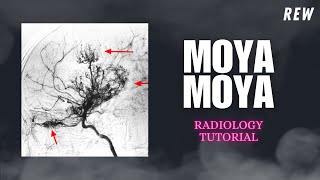 Download Lagu Moya Moya Disease Radiology Tutorial | #radiology MP3