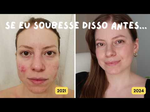 Espinhas Inflamadas: o que você precisa saber para controlar a acne (e o deve e NÃO deve fazer!)