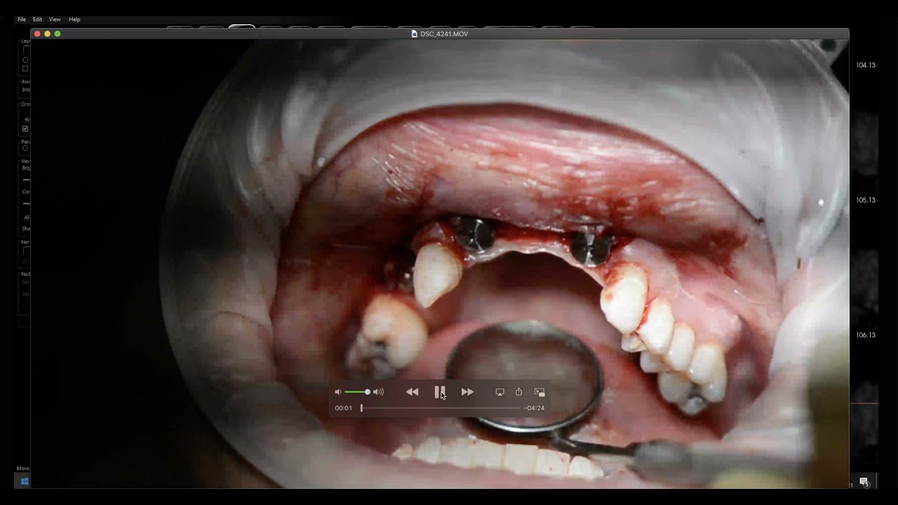 Periosteal Release YouTube