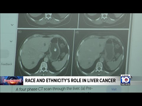 Study examines population risks associated with liver cancer