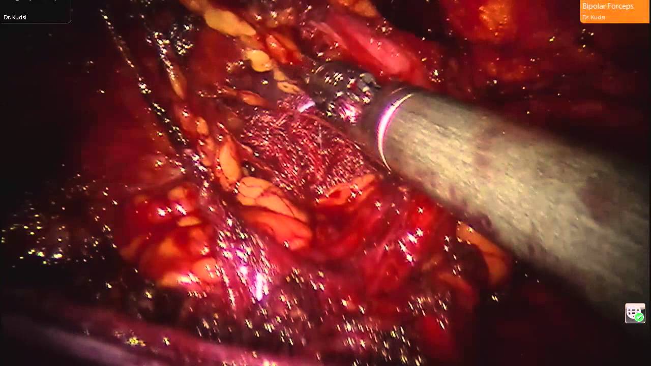 robotic surgery disadvantages Robotic Inguinal Hernia Repair (r-TAPP).