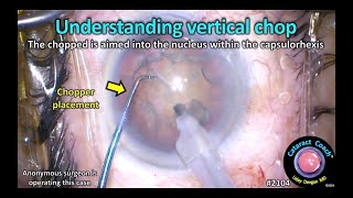 CataractCoach™ 2104: understanding vertical chop cataract surgery