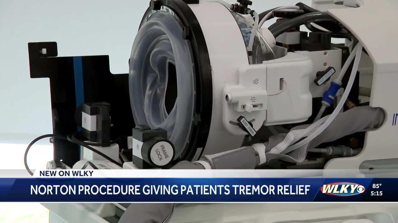 Norton's high-intensity focused ultrasound procedure giving patients tremor relief