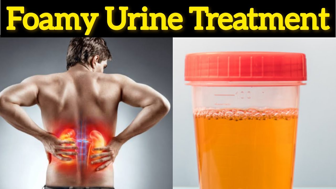 Vitamin Miracle Say Goodbye to Proteinuria Foamy Urine Treatment